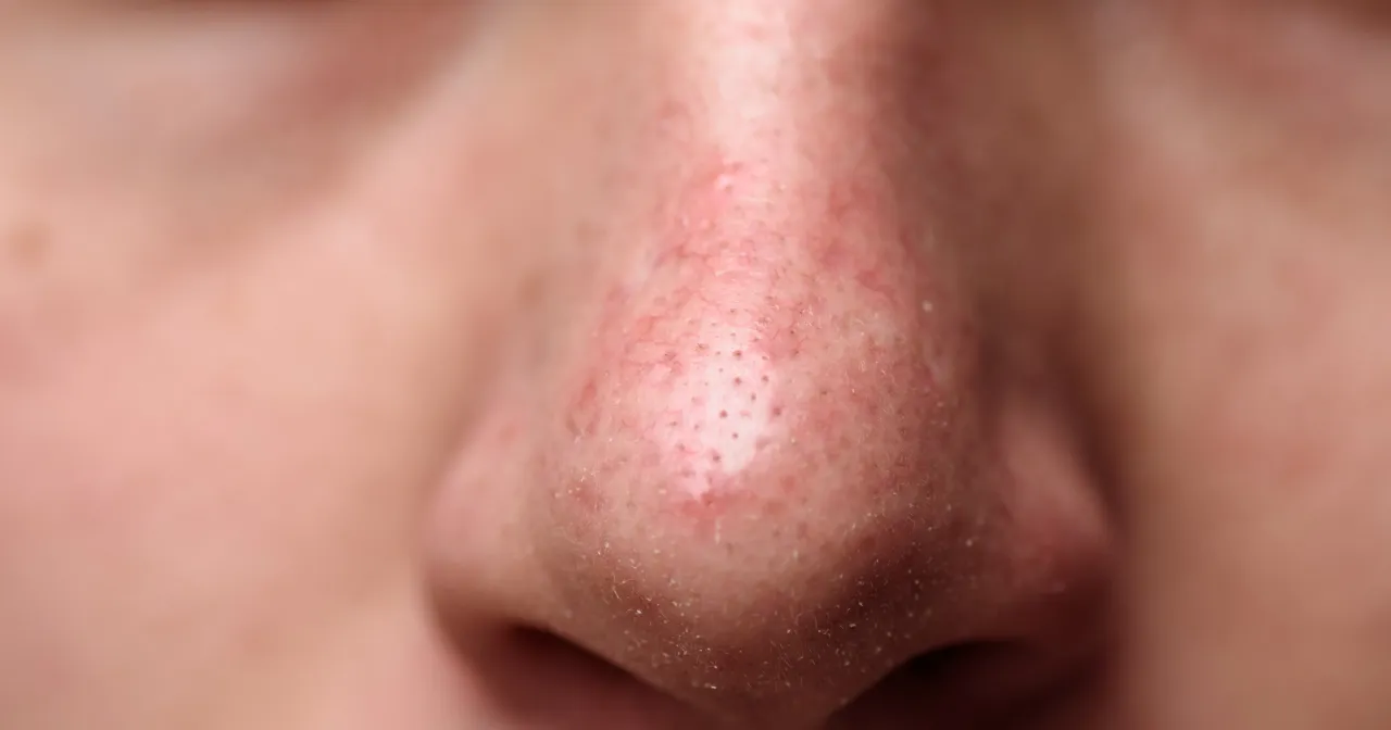 Doraźne sposoby na pryszcze