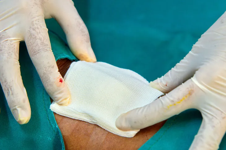 Prawidłowa zmiana opatrunku na ranie krok po kroku