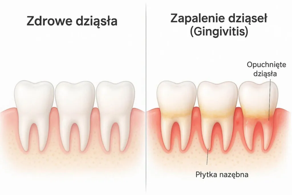zdrowe dziąsła vs zapalenie dziąseł porównanie