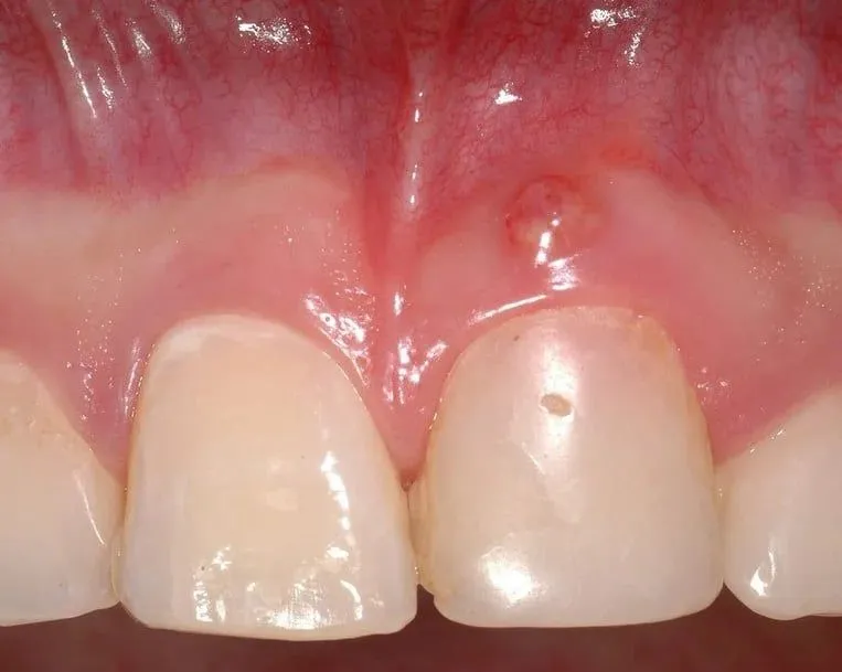 ropień na dziąśle u dziecka zdjęcia