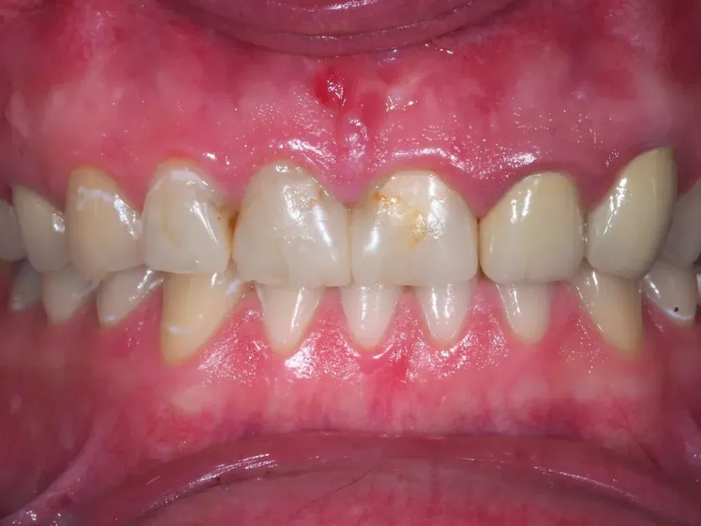 objawy zapalenia dziąseł por&oacute;wnanie stadium