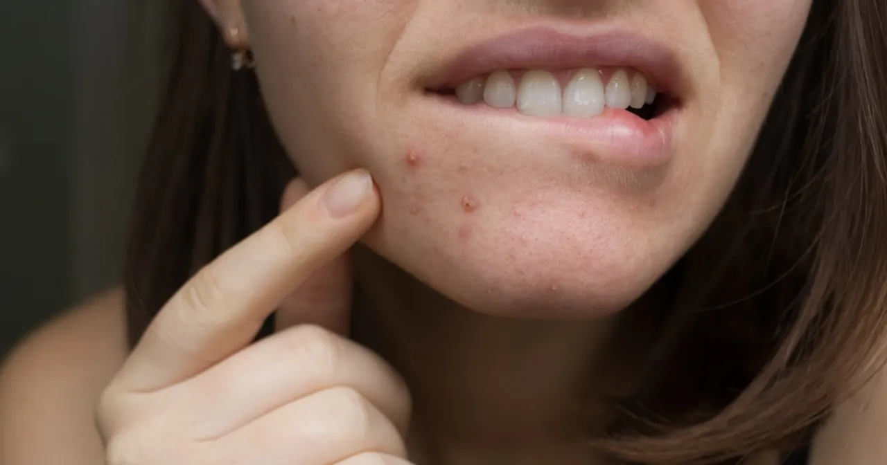 Szybkie sposoby na pojedynczego pryszcza