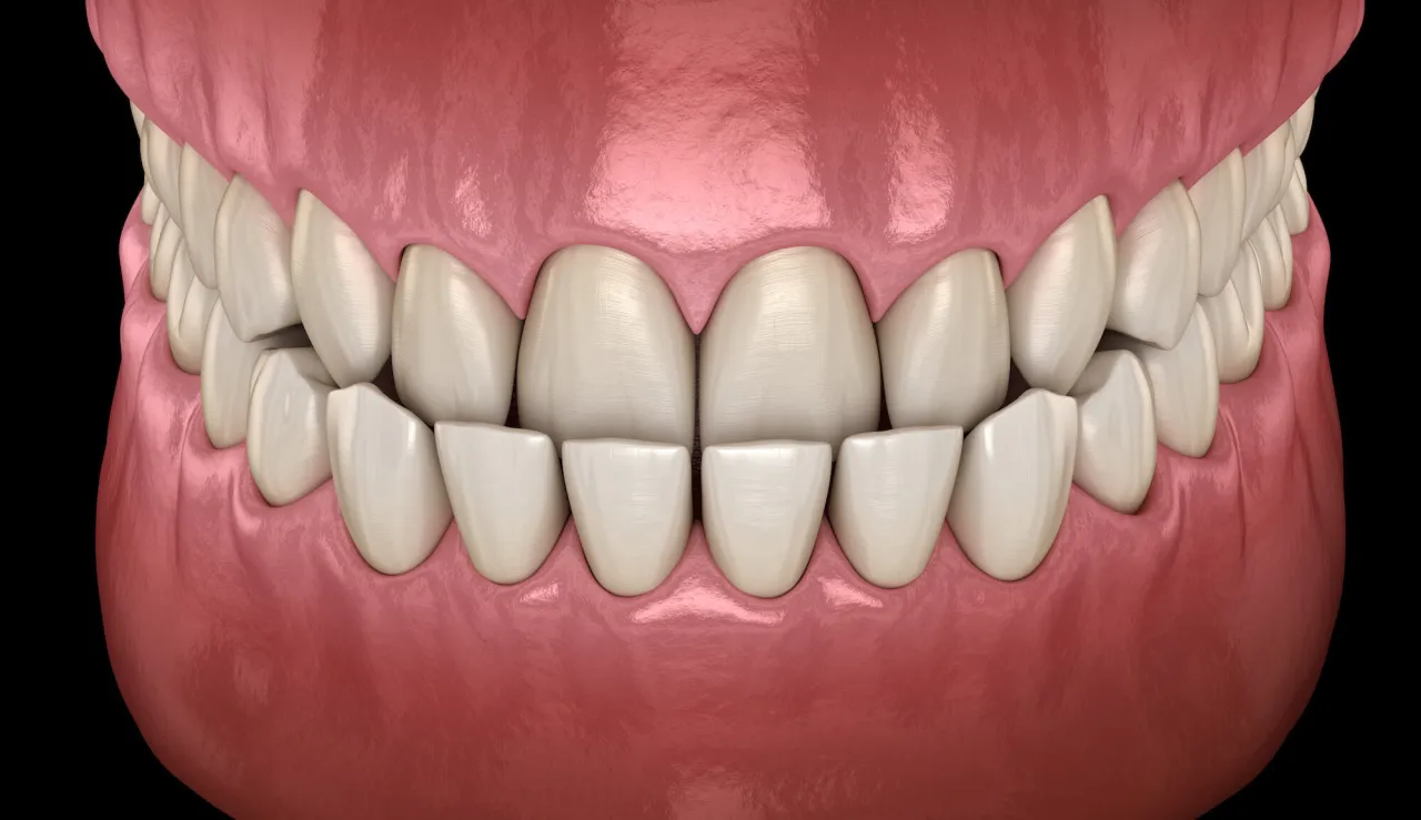 konsekwencje nieprawidłowego zgryzu