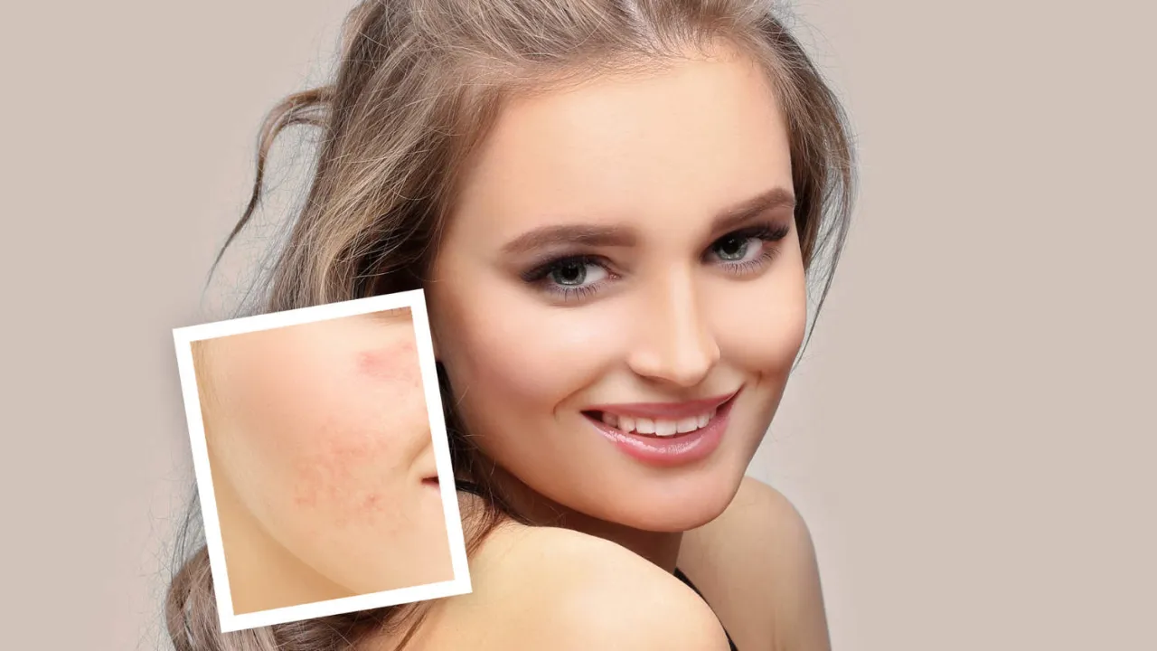 Uśmiechnięta kobieta z gładką cerą obok zdjęcia pokazującego, czym wybielić czerwone plamy po pryszczach.
