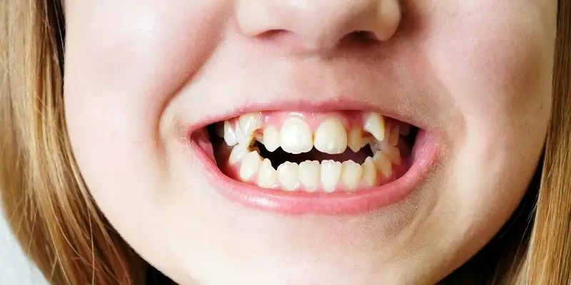 przykłady wad zgryzu u dzieci