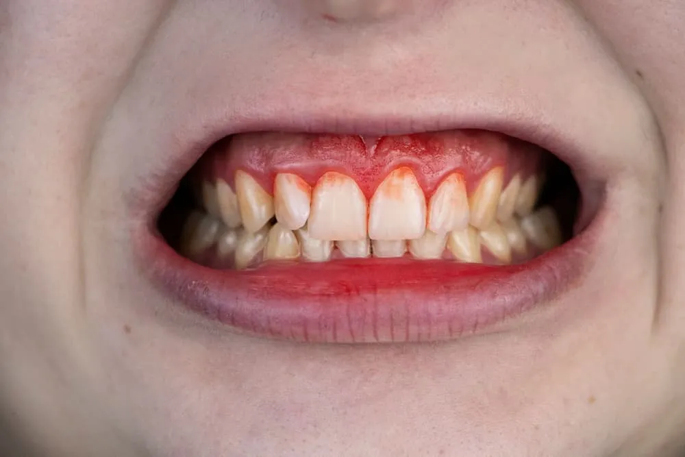 objawy szkorbutu dziąsła sk&oacute;ra