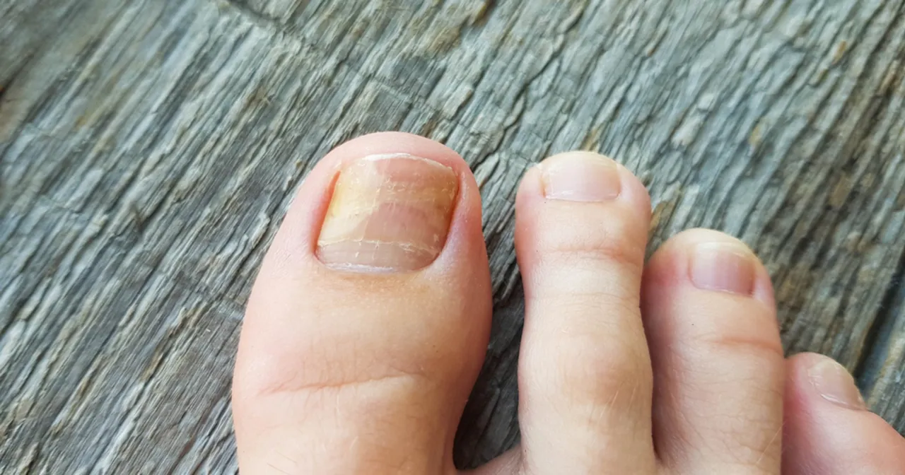 Lakiery na grzybicę paznokci bez recepty por&oacute;wnanie