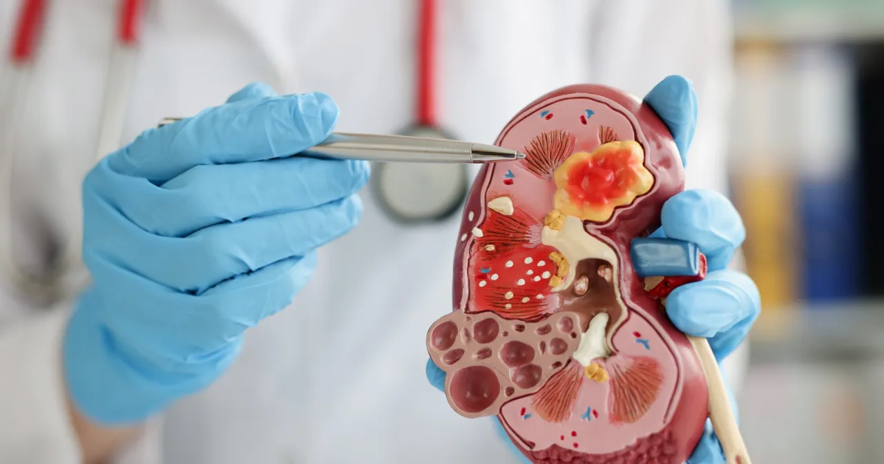 Przyczyny podwyższonej kreatyniny