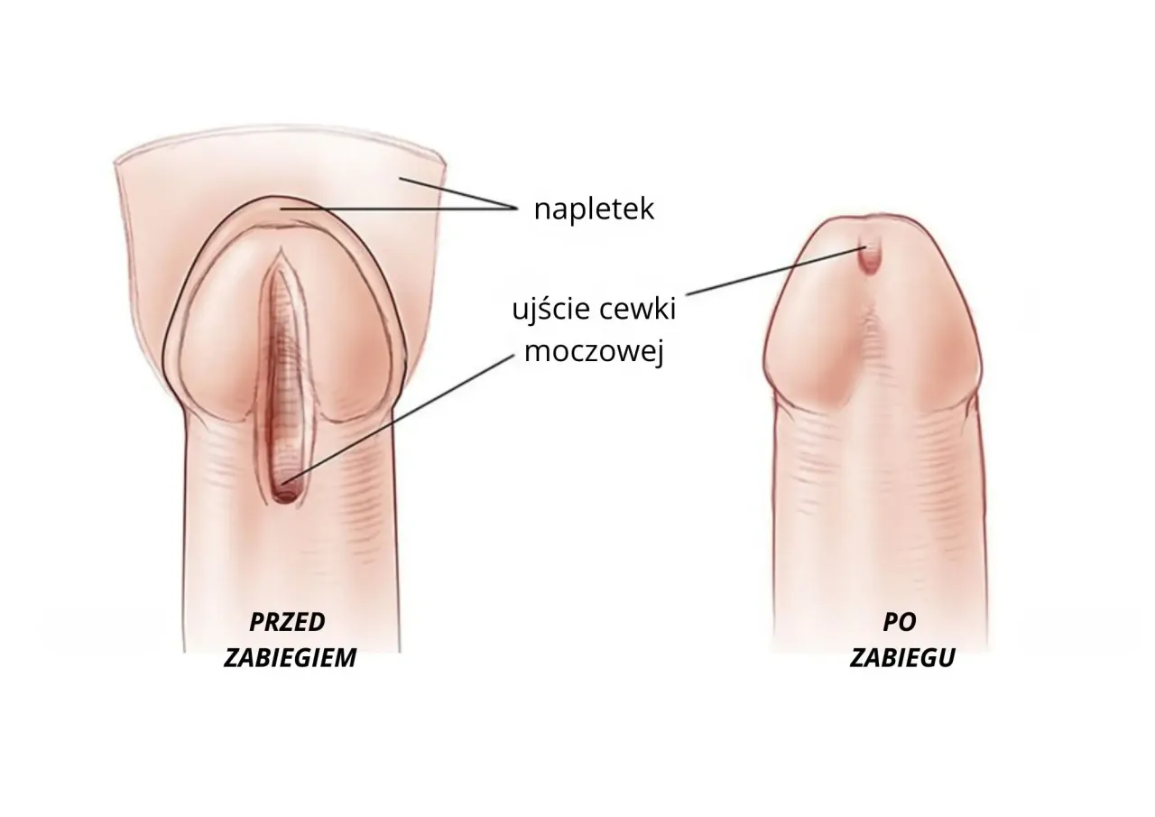 schemat zwężenia cewki moczowej