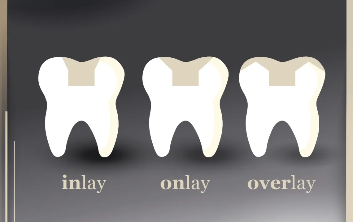 inlay onlay dentystyka porównanie