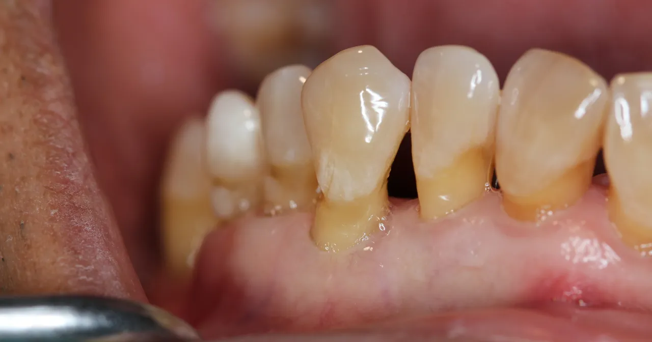 recesja dziąseł objawy wizualne