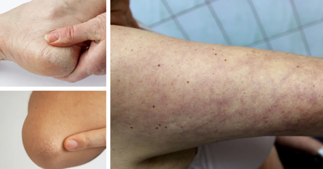 Skóra sucha, łuszcząca się na łokciach i dłoniach, a także przebarwienia na ramieniu mogą być objawami niedoczynności tarczycy.