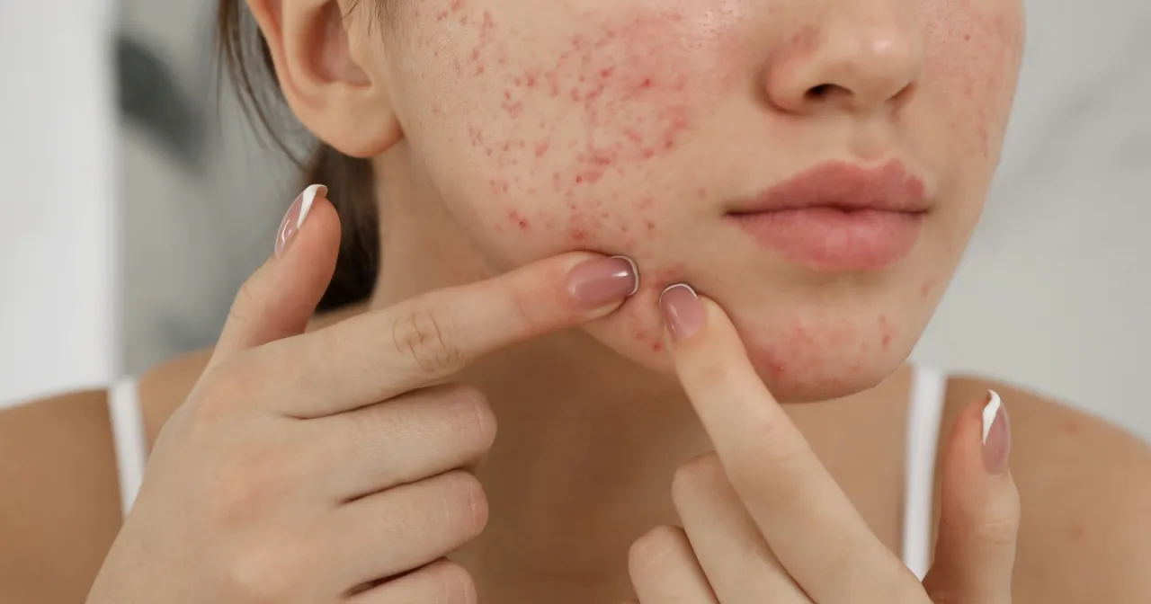 Szybkie sposoby na pryszcze przed wyjściem, plastry na wypryski