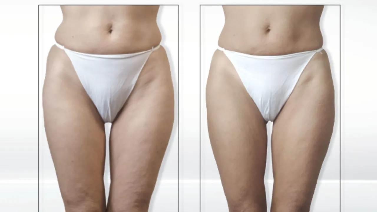 Harmonogram zabiegów endermologii grafika