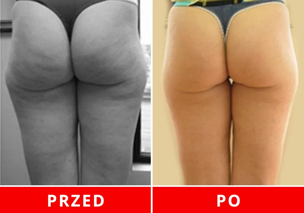 Kobieta z cellulitem przed i po transformacji