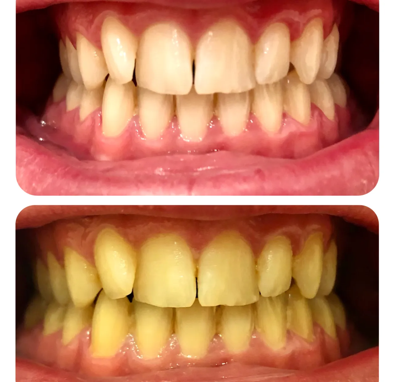 Porównanie metod profesjonalnego wybielania zębów