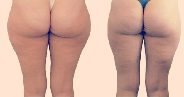liposukcja przed i po różne obszary