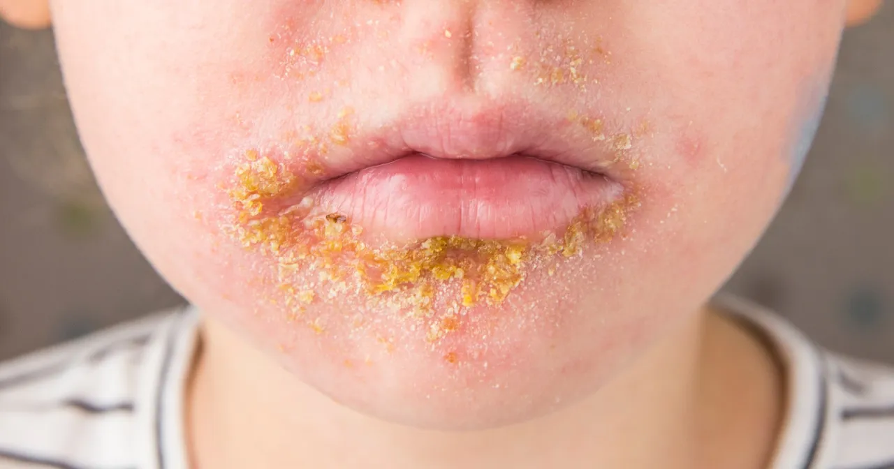 objawy gronkowca w jamie ustnej