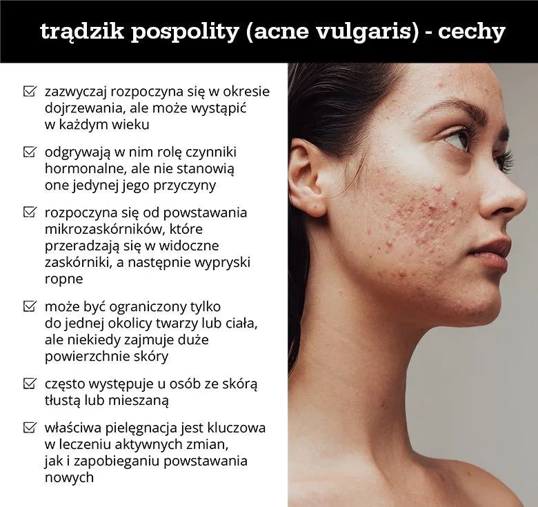 Przyczyny trądziku na policzkach infografika