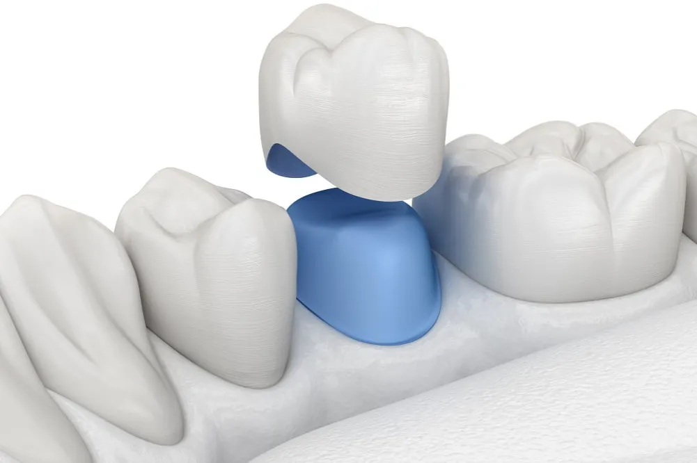 nowoczesne metody odbudowy zębów