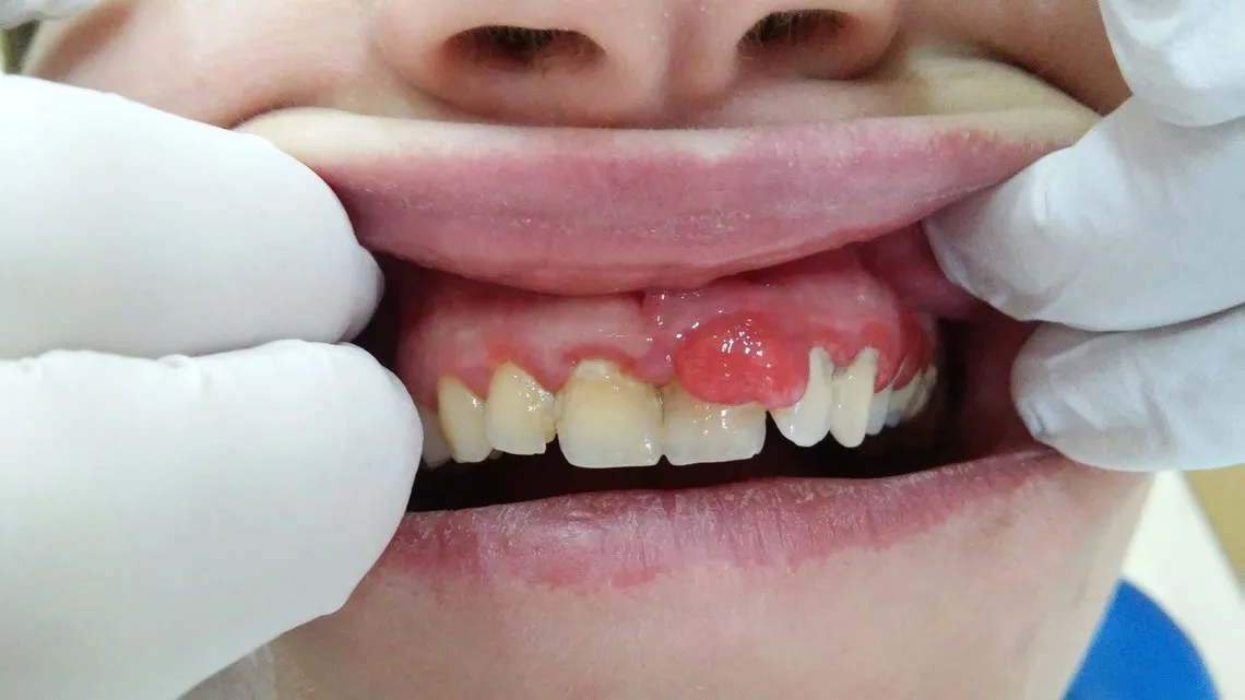 Choroby dziąseł i błony śluzowej jamy ustnej