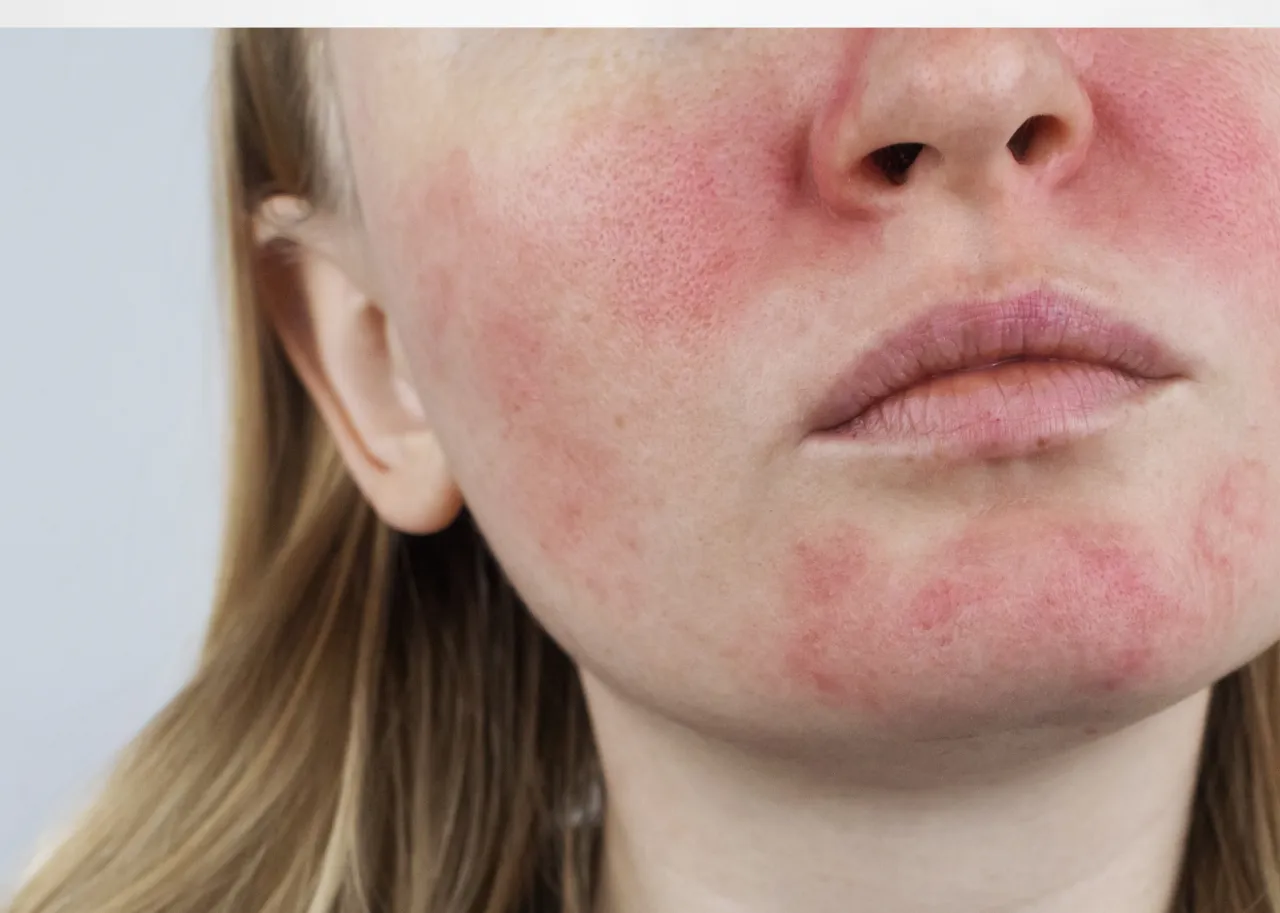 kobieta chroniąca twarz przed mrozem i wiatrem, cera naczynkowa