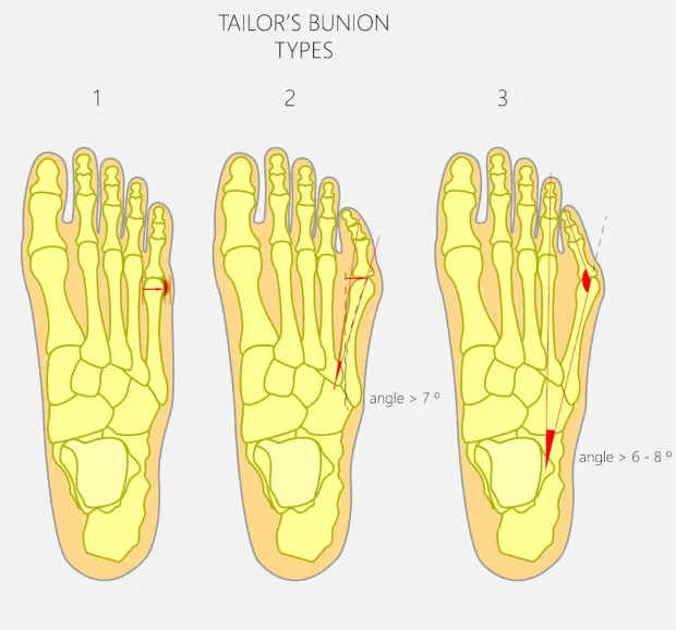 Operacja haluksa małego palca schemat