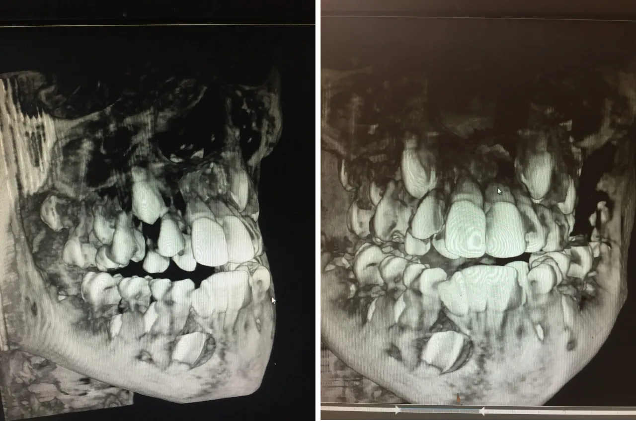 rentgen zęb&oacute;w hipodoncja hiperdoncja