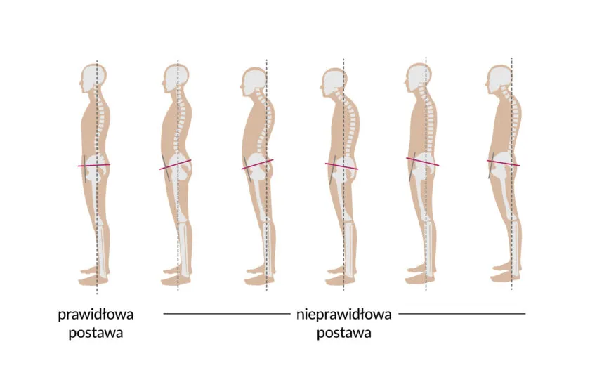 prawidłowa postawa ciała vs zgarbiona sylwetka