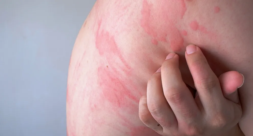 Zdjęcie Alergia na wołowinę objawy – jak je rozpoznać i uniknąć zagrożeń