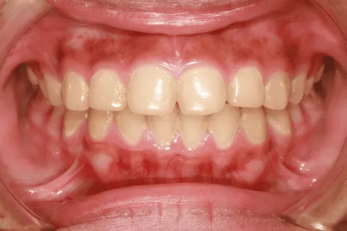 Zdjęcie Jak skutecznie leczyć zapalenie dziąseł i uniknąć poważnych problemów