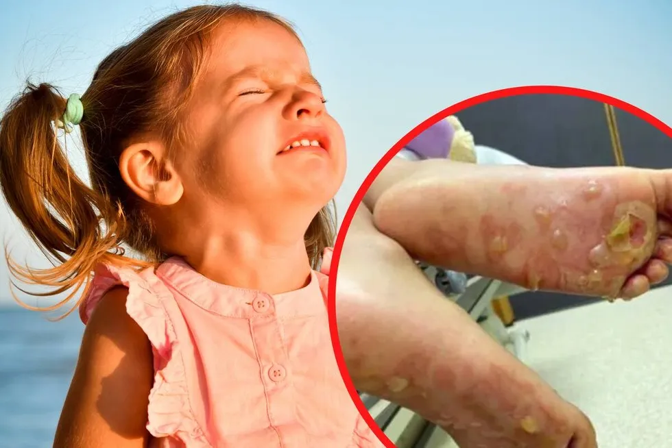 dziecko poparzone słońcem na plaży