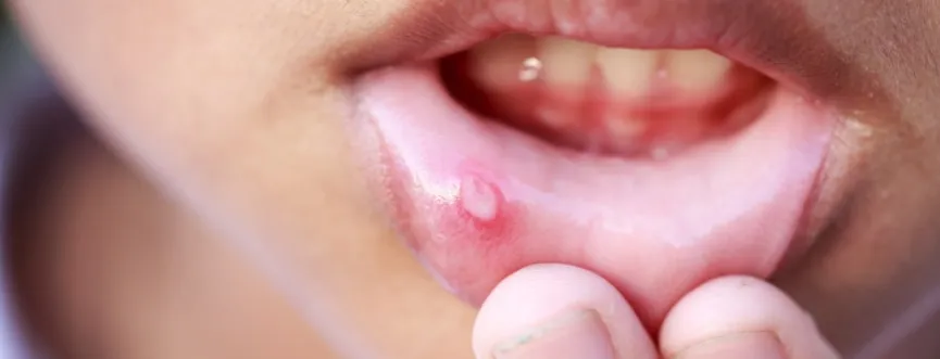 afty u dziecka zdjęcia, jak wyglądają afty u niemowlaka