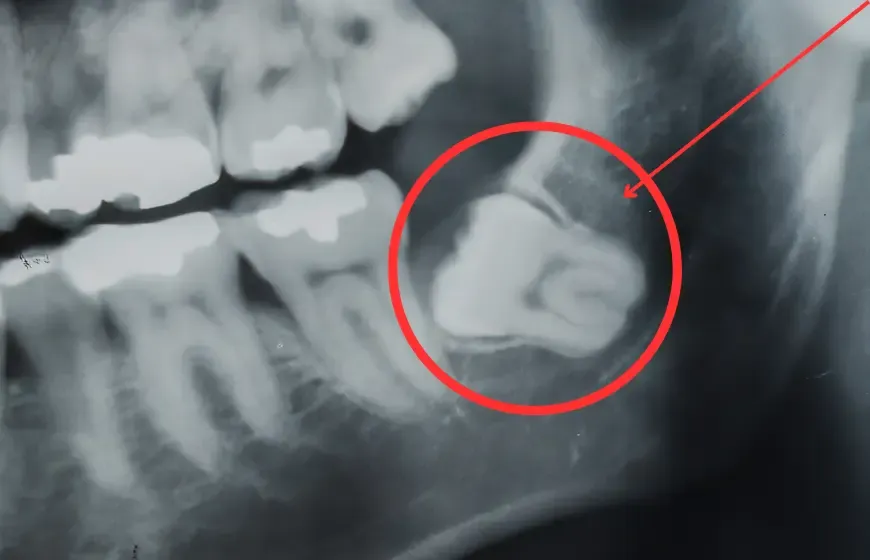 Zatrzymana &oacute;semka rentgen