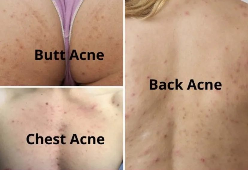 skóra pleców z trądzikiem i bez porównanie