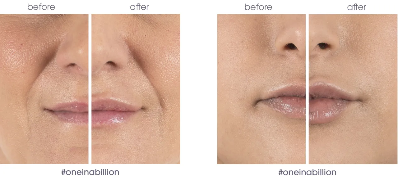 naturalne wchłanianie kwasu hialuronowego w ustach