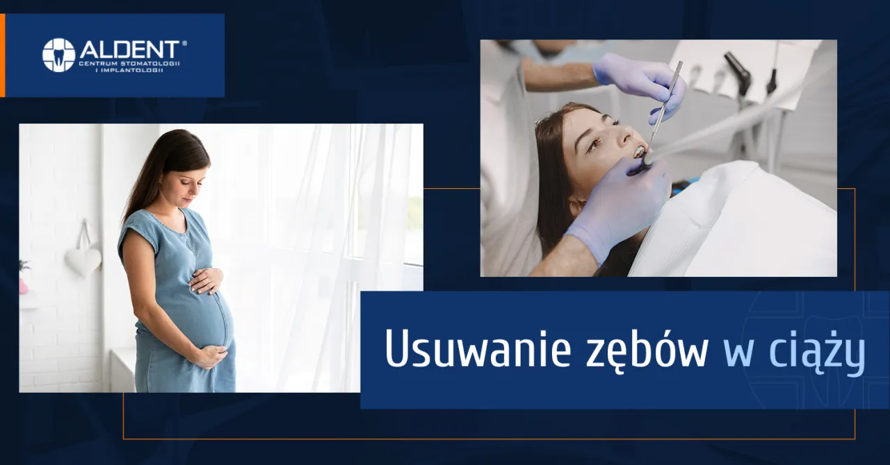 Zdjęcie Czy można wyrywać zęba w ciąży? Bezpieczeństwo i ryzyka, które musisz znać