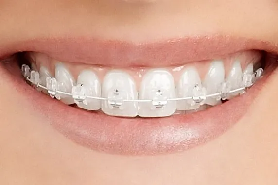 rodzaje aparatów ortodontycznych metalowy estetyczny samoligaturujący