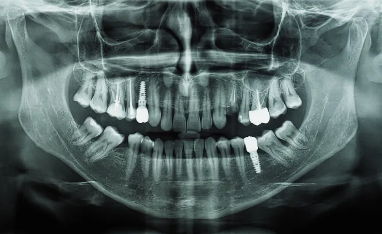 rentgen pantomograficzny zęby mądrości