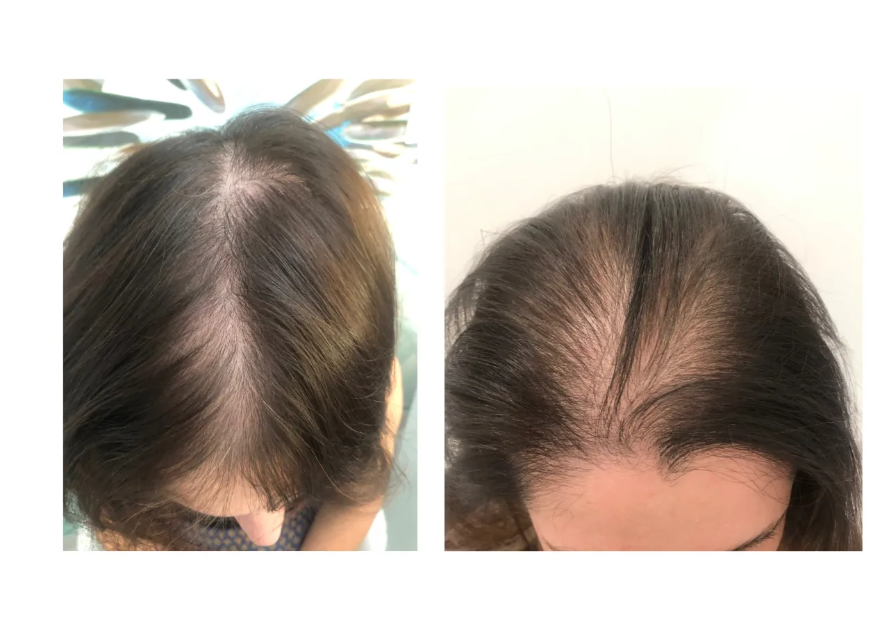 Kobieta zmęczona, trądzik, wypadające włosy, problemy z wagą