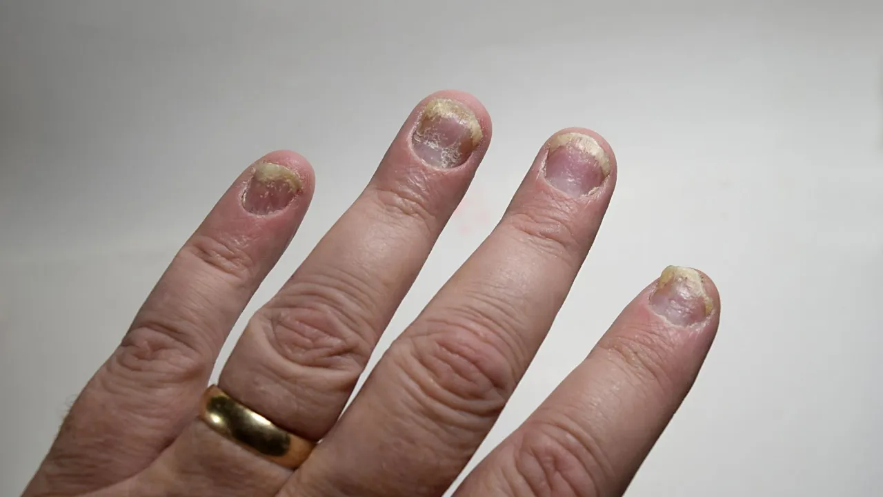 Różnice grzybica łuszczyca paznokci
