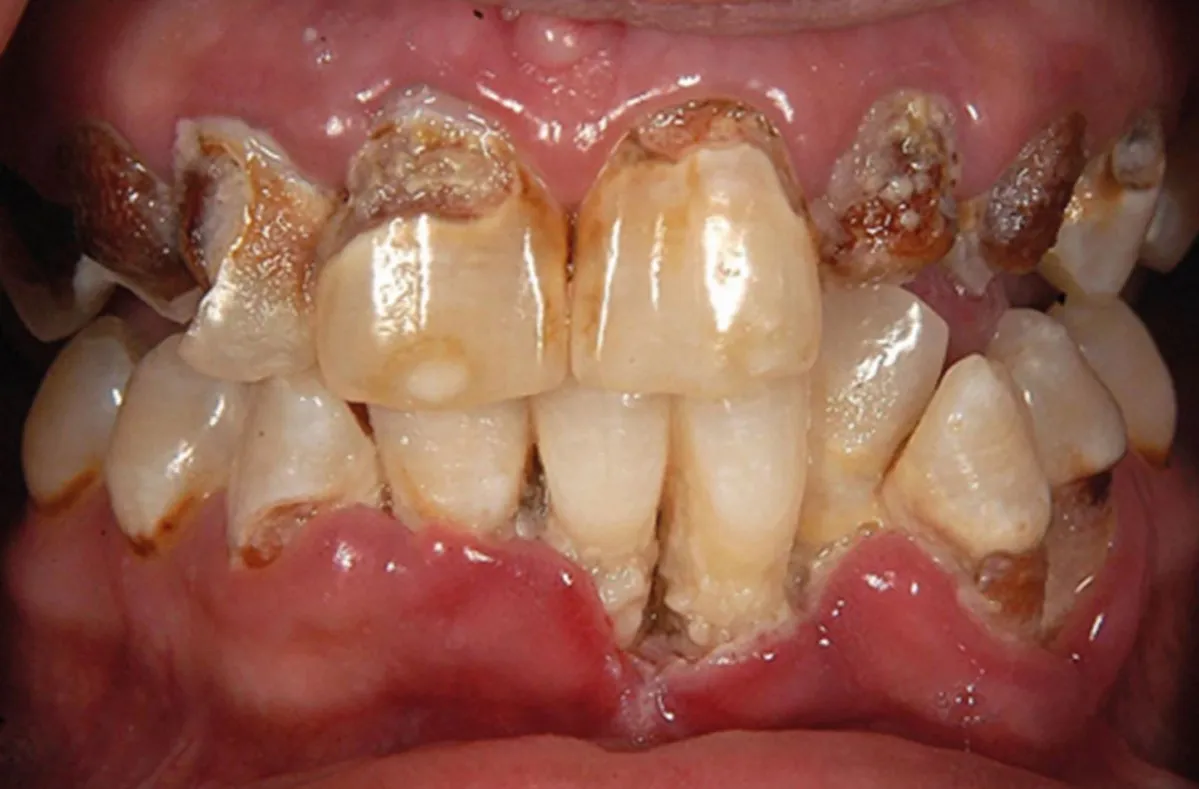 Meth mouth zęby zniszczone metamfetamina