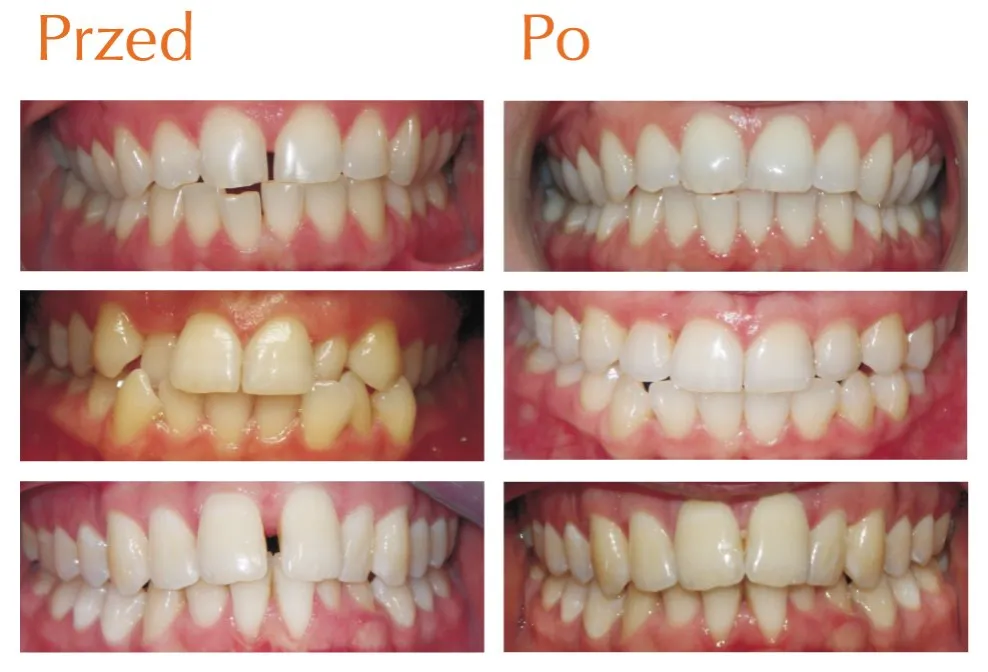 Przezroczyste nakładki ortodontyczne przed i po