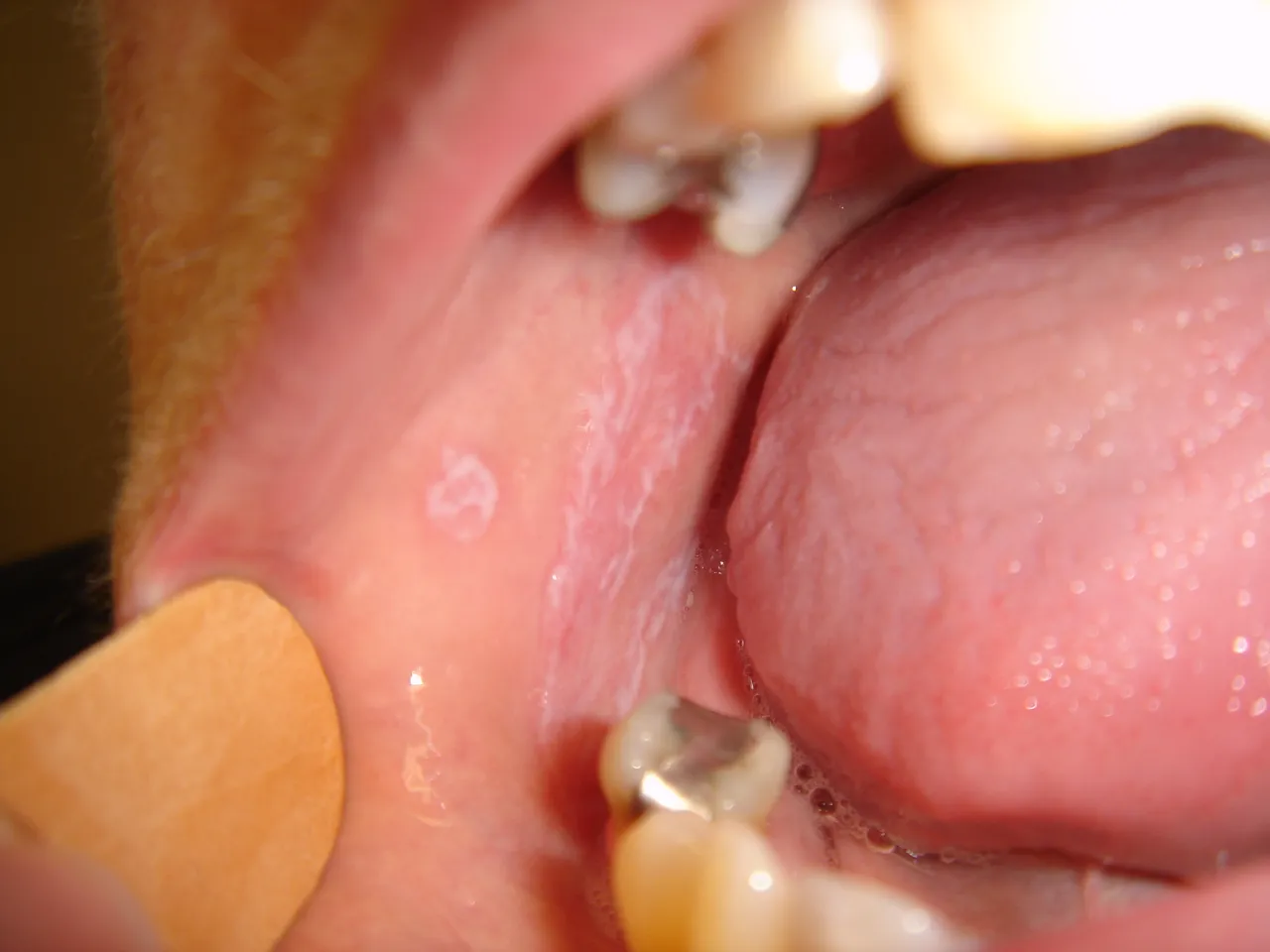 Liszaj płaski w jamie ustnej objawy siateczka Wickhama