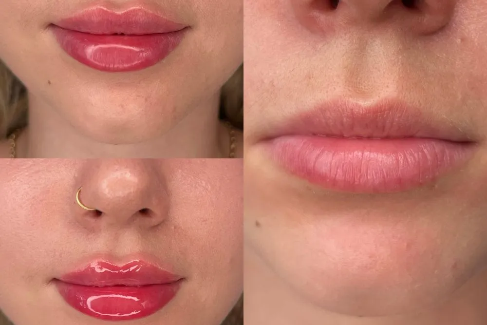 Powiększanie ust kwasem hialuronowym efekty