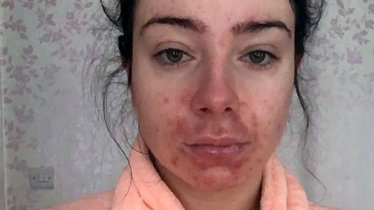 Dziewczyna patrzy w lustro z pryszczem na twarzy, zmartwiona, szuka szybkiego rozwiązania