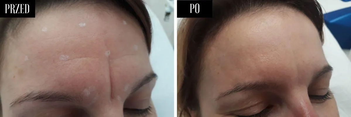 Botoks przed i po lwia zmarszczka