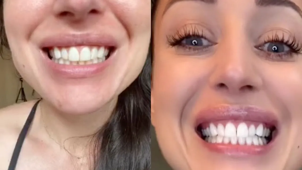 domowe wybielanie zęb&oacute;w kurkumą przed i po