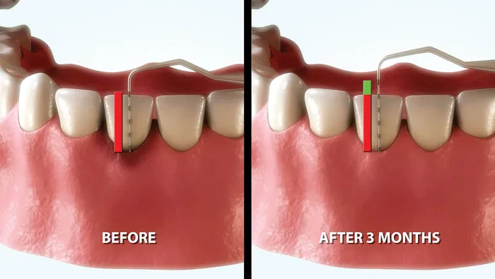 leczenie paradontozy zabiegi