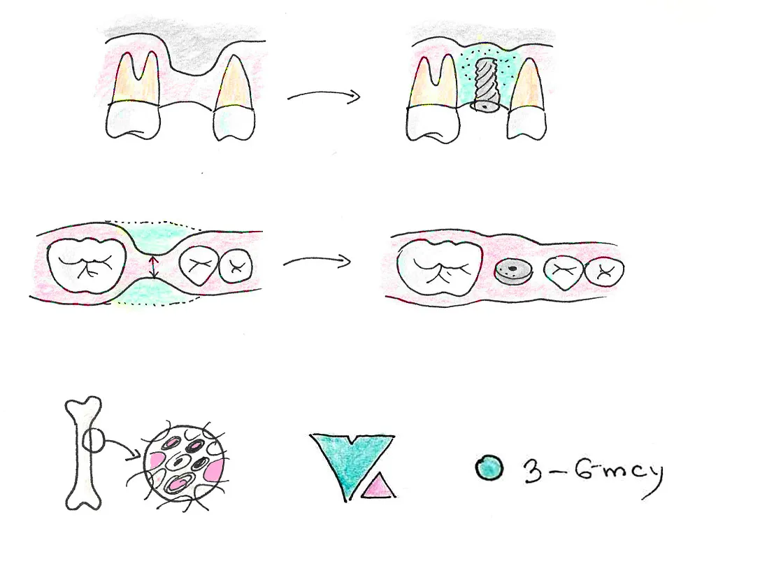 augmentacja zębodołu schemat